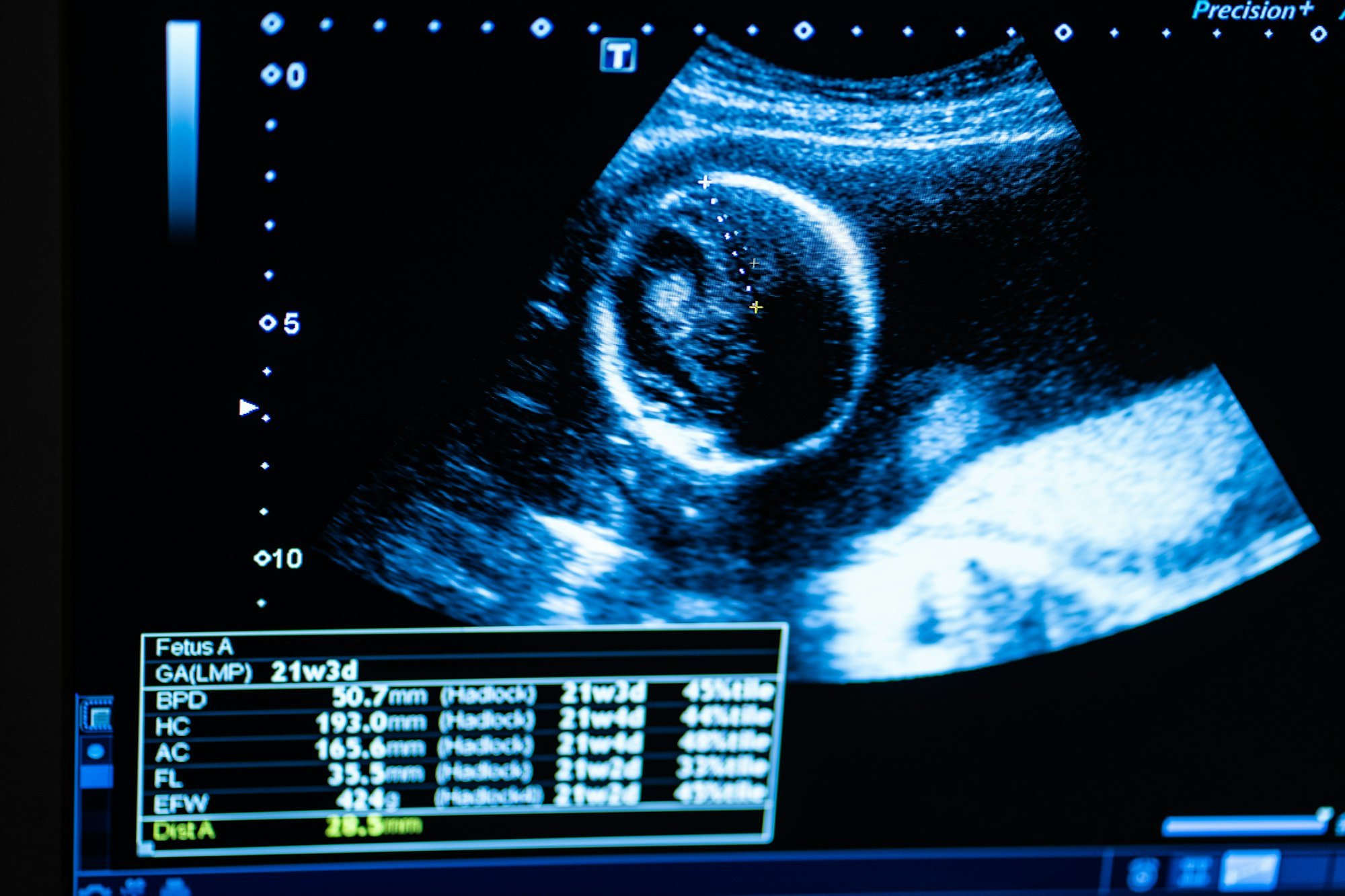 Monitor during ultrasound examination. Pregnancy.